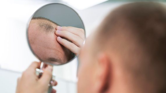 Panduan Memilih Klinik Transplantasi Rambut Terbaik agar Anda Tidak Rugi