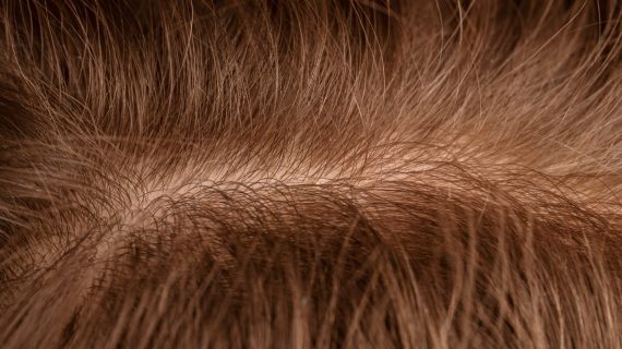 Kenapa Pertumbuhan Rambut Lambat? Ini Fase, Penyebab, Dan Cara Mengatasinya