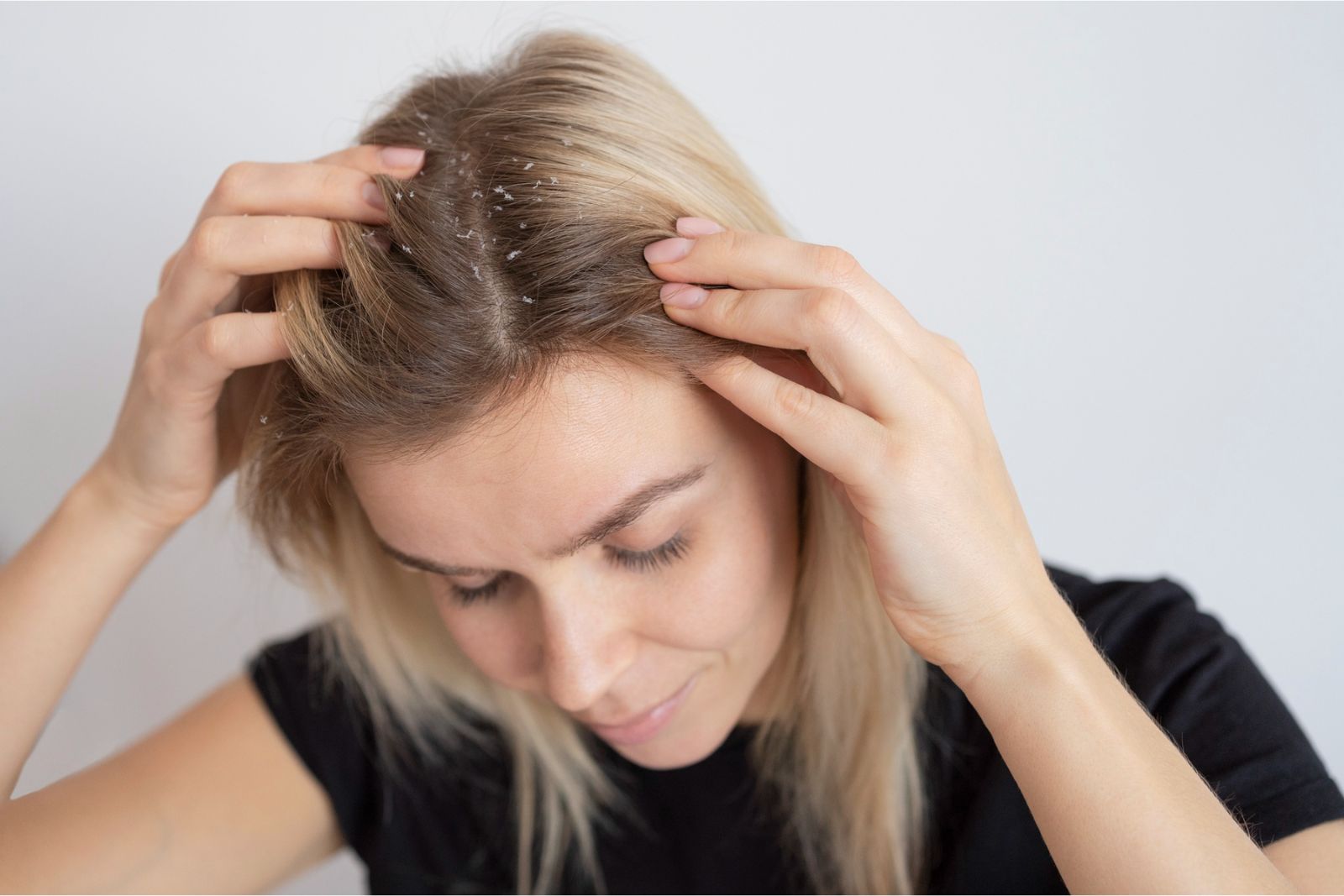 cara mengatasi rambut rontok dan ketombe