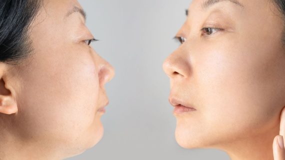 Apakah Double Chin Bisa Hilang? Ini Dia Jawabannya!