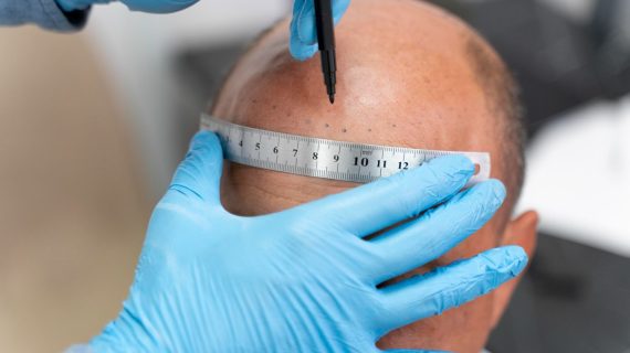 Berapa Jumlah Graft yang Dibutuhkan untuk Tanam Rambut?