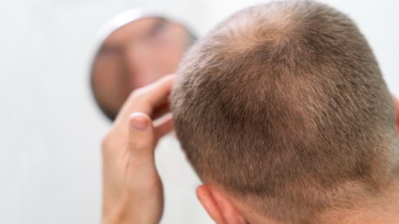 DHI vs FUE vs FUT: Perbandingan Lengkap Metode Tanam Rambut yang Perlu Anda Tahu