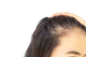 Rambut Pitak Wanita: Penyebab, Cara Mengatasi, dan Solusi Efektif