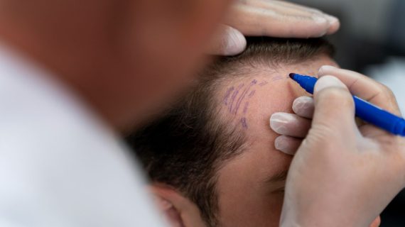 Siapa Saja yang Cocok untuk Tanam Rambut? Ini Penjelasan Lengkapnya