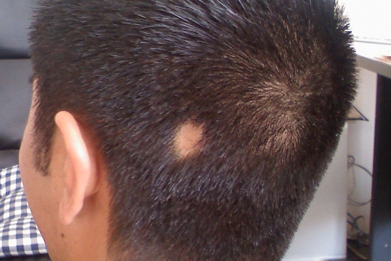 cara mengatasi alopecia areata