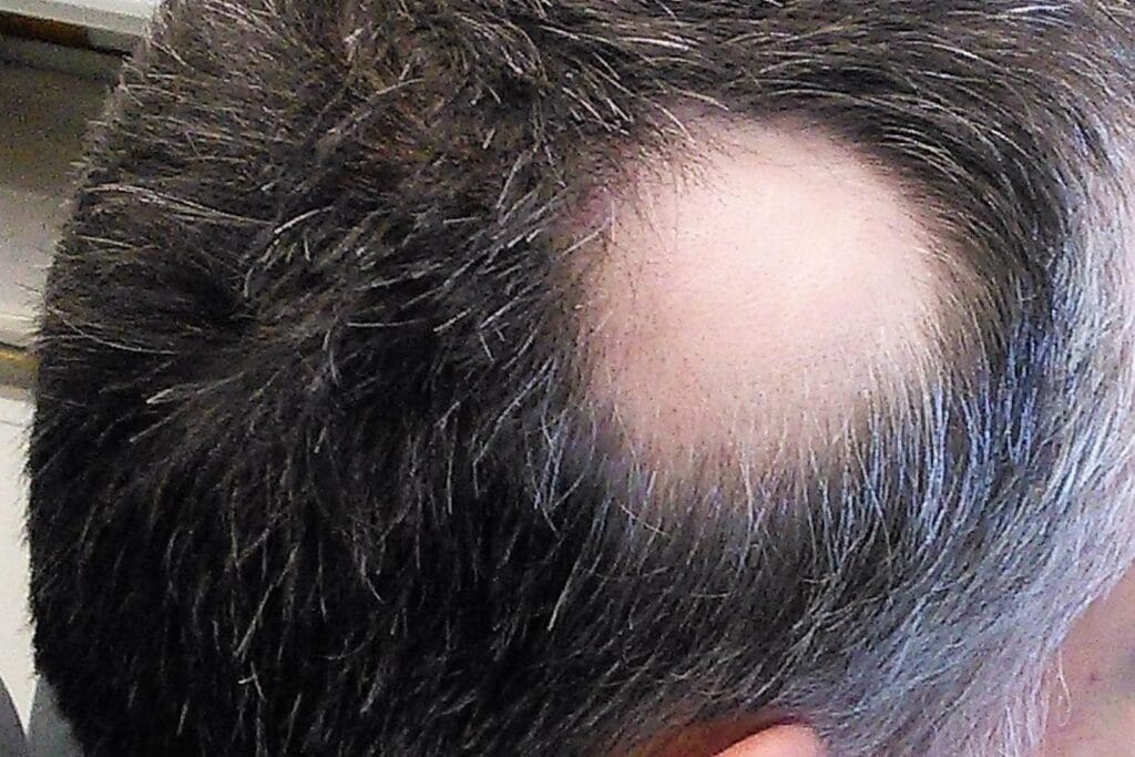 klinik tanam rambut untuk alopecia areata