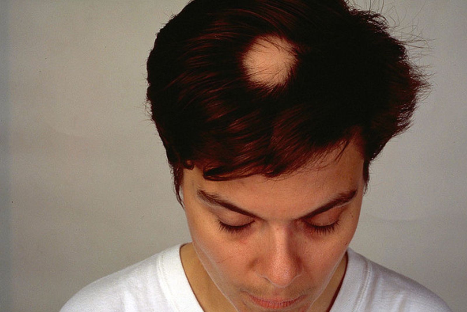 solusi untuk alopecia areata