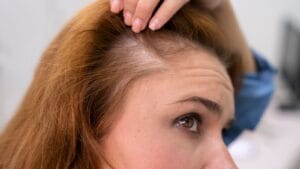 tanam rambut untuk alopecia