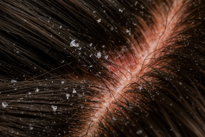 psoriasis pada rambut