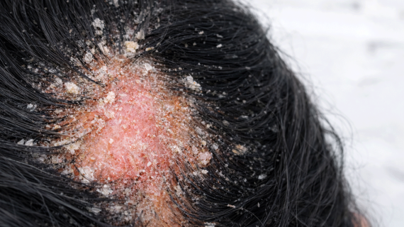 Kulit Kepala Berjamur: Kenali Penyebab dan Perawatannya