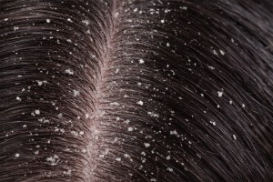 Ketombe Berkerak: Masalah Kulit Kepala yang Tak Boleh Diabaikan