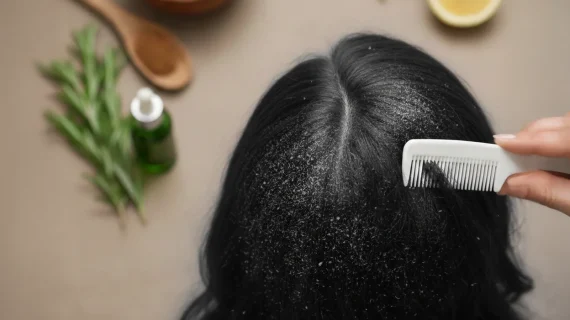 Cara Menghilangkan Ketombe Kering dengan Tepat