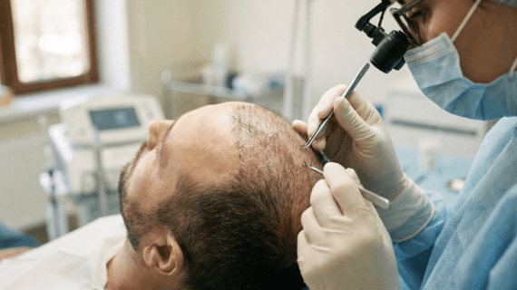 Transplantasi Rambut Tanpa Cukur: Solusi Estetis untuk Hasil Alami