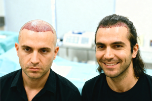 Transplantasi Rambut Tanpa Botak