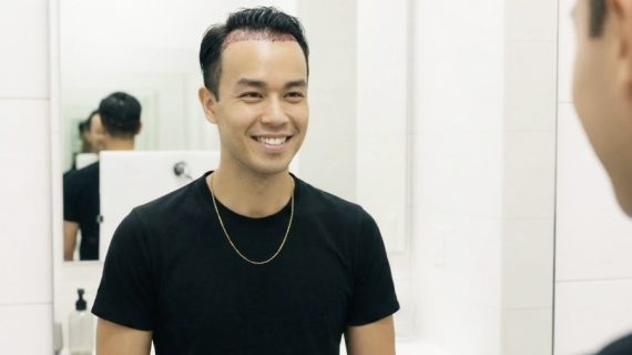 Unshaven FUE: Transplantasi Rambut Tanpa Mengubah Penampilan