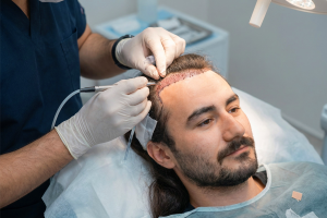 Mengenal Teknik Unshaven Follicular Unit Extraction