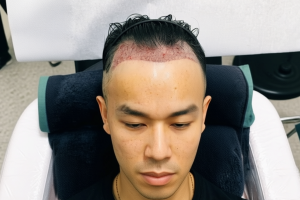 Hair Transplant Tanpa Cukur