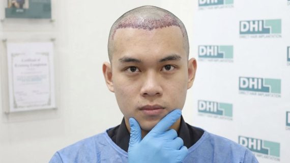 Cangkok Rambut: Cara Efektif Mengatasi Kebotakan Permanen