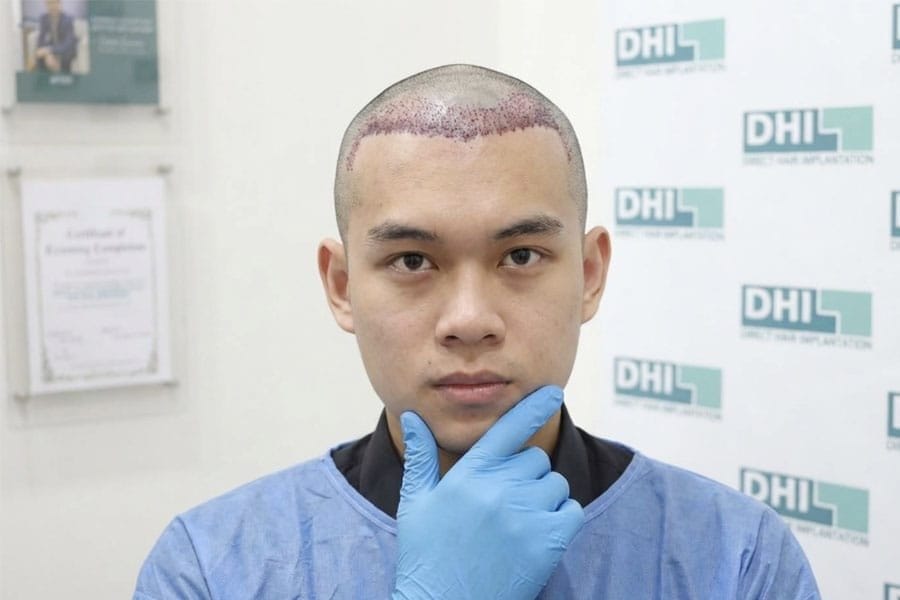 cangkok rambut