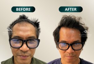 before-after1