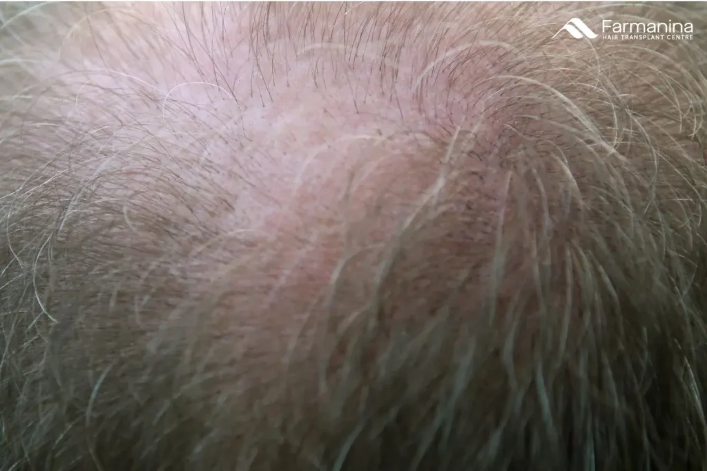 Kebotakan pada rambut