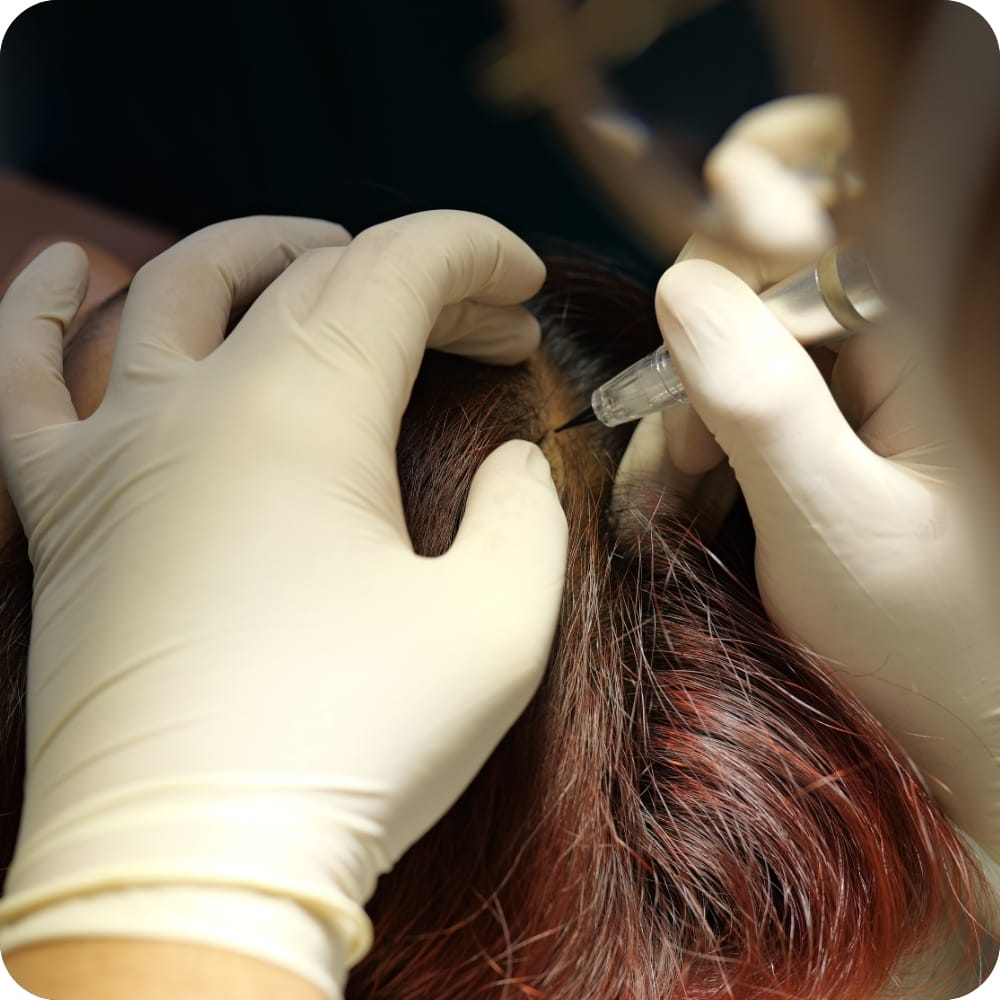Prosedur Scalp Micro Pigmentation SMP non bedah di Farmanina Clinic