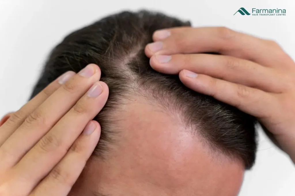 Pria sedang melihat kondisi rambut di cermin sebagai ilustrasi penyebab kebotakan pada pria