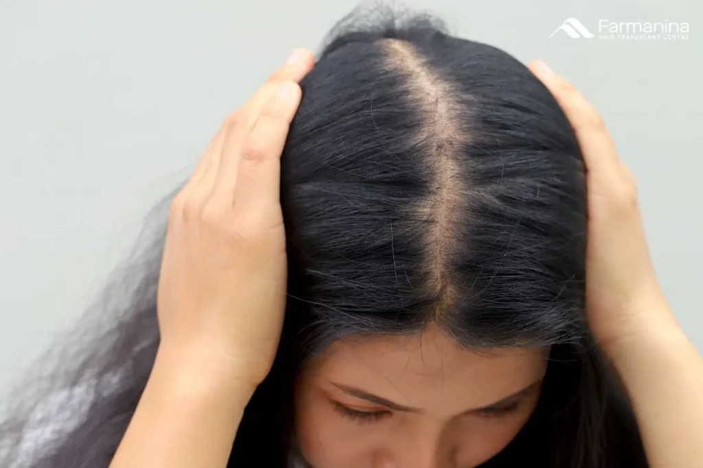 Kebotakan pada wanita