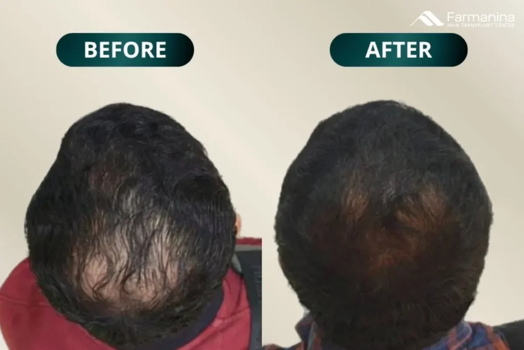 Hair PRP treatment di Farmanina Clinic
