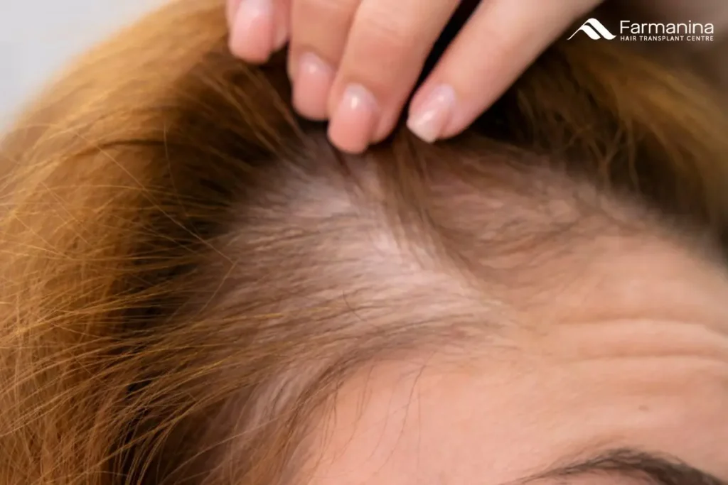 Penipisan rambut di area pelipis