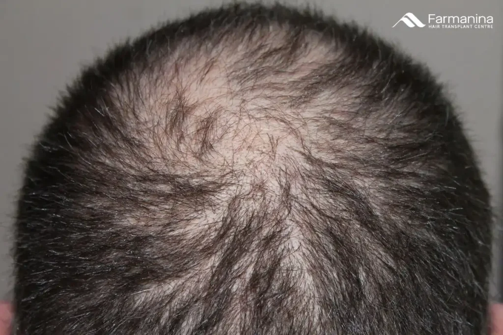 Pria dengan rambut yang botak