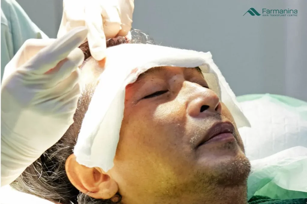 Proses Long Hair Transplant di Farmanina Clinic