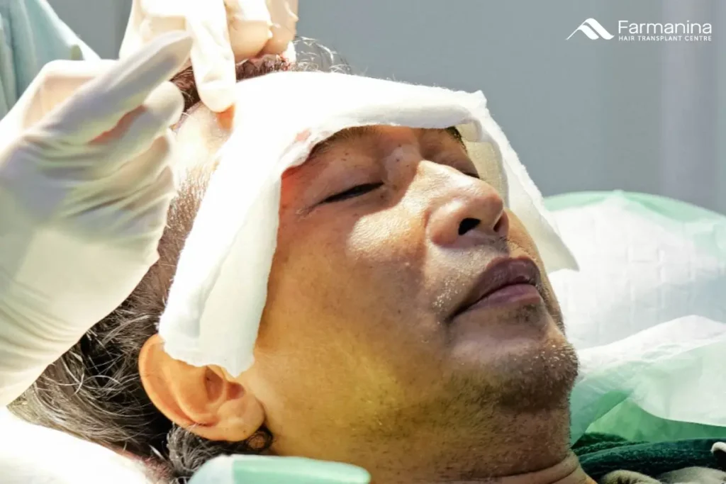 Long hair transplants dari Farmanina Clinic