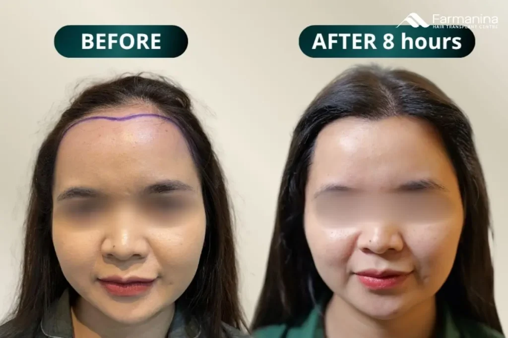 Before-after tanam rambut di Farmanina Clinic