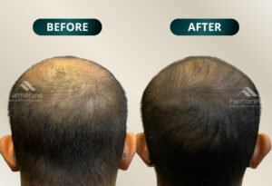 Perbandingan sebelum sesudah terapi Hair Exosome untuk mengaktifkan folikel rambut di Farmanina Clinic