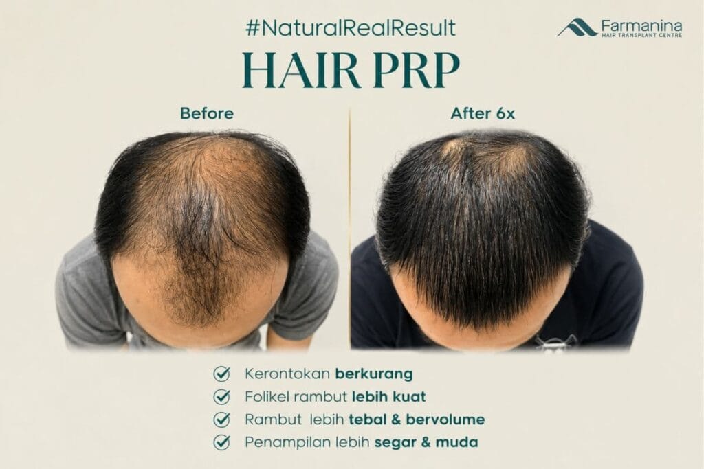 Before and after PRP di Farmanina Clinic