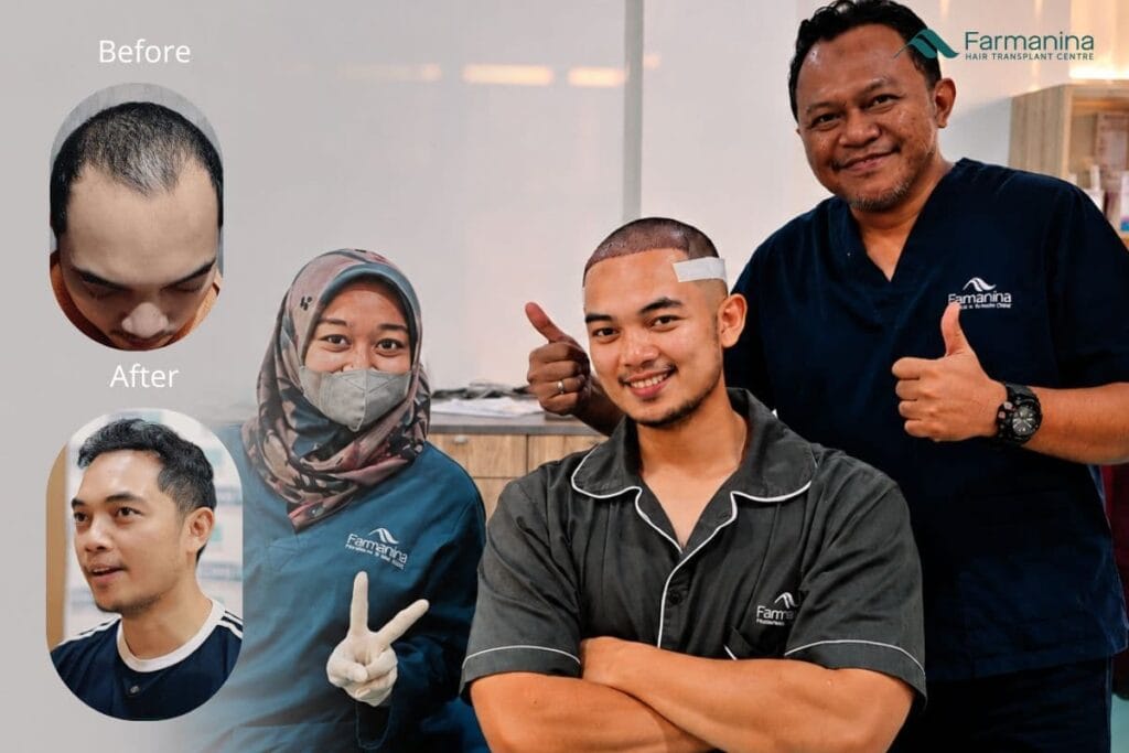 Hasil transplantasi rambut dengan metode DHI di Farmanina Clinic