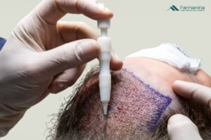 Proses hair transplantation dengan metode DHI