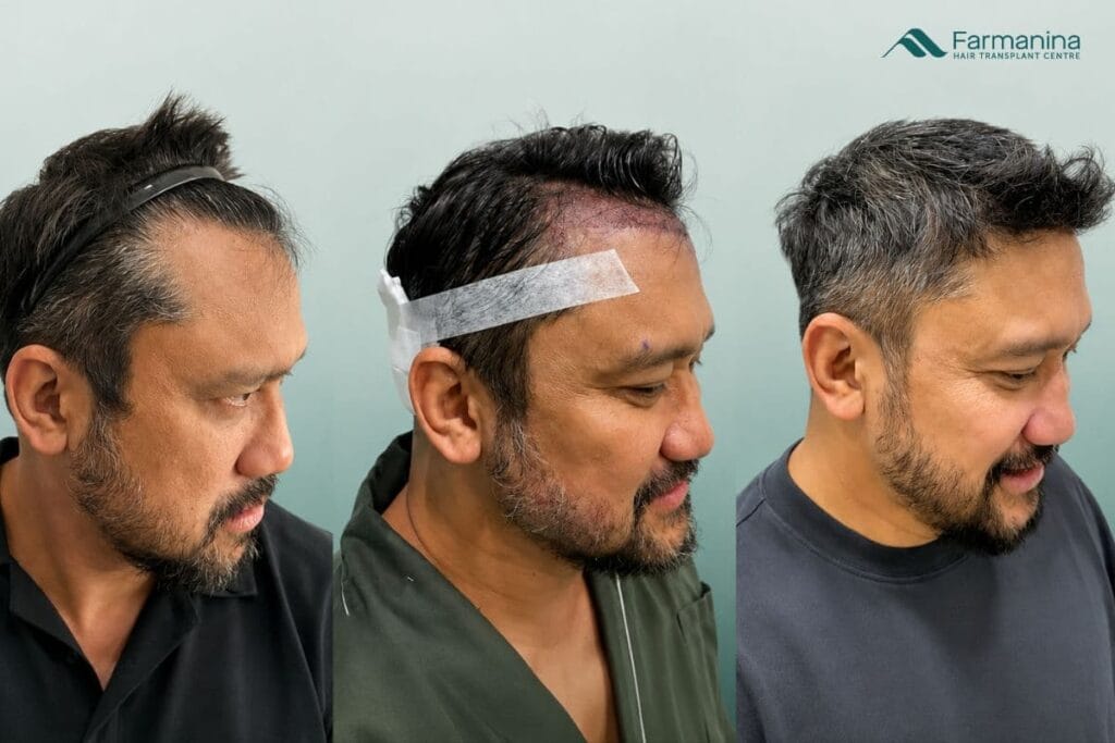 Hasil tanam rambut di Farmanina Clinic