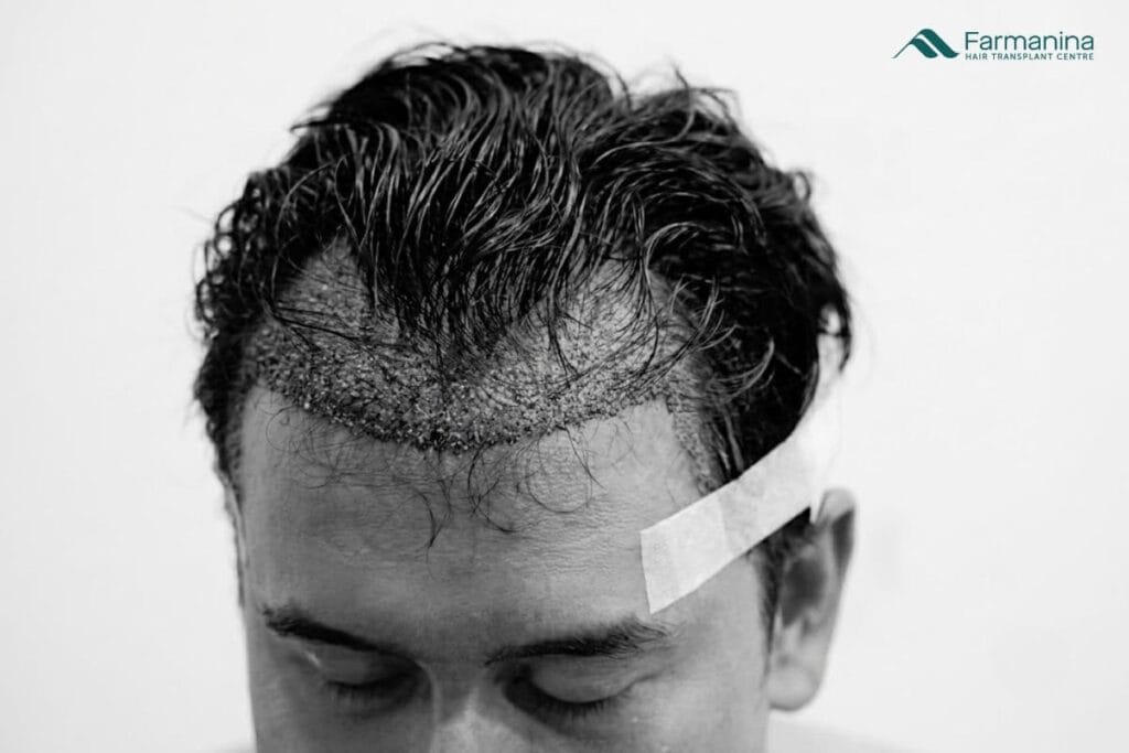 Keadaan rambut setelah DHI