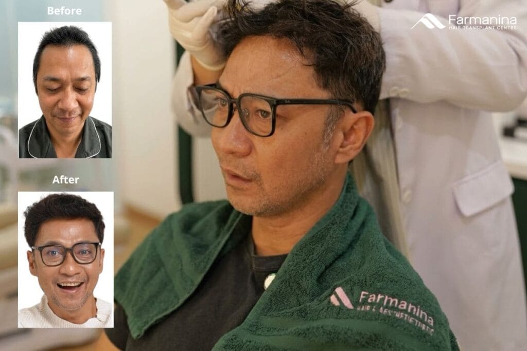 Hasil tanam rambut di Farmanina Clinic