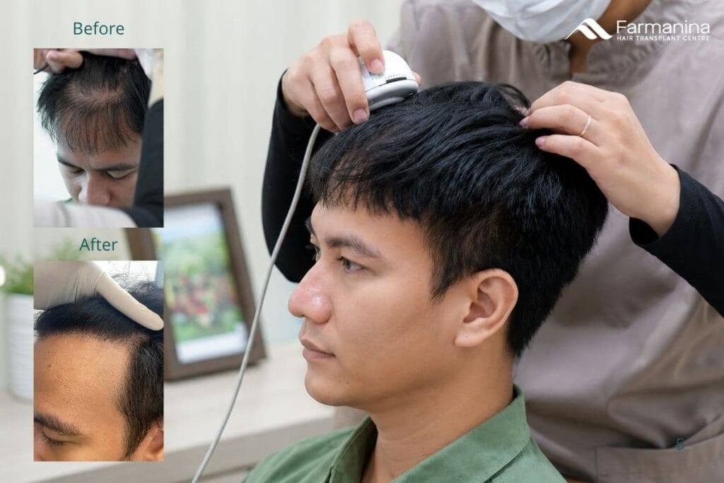 Hasil Hair Transplant Farmanina Clinic