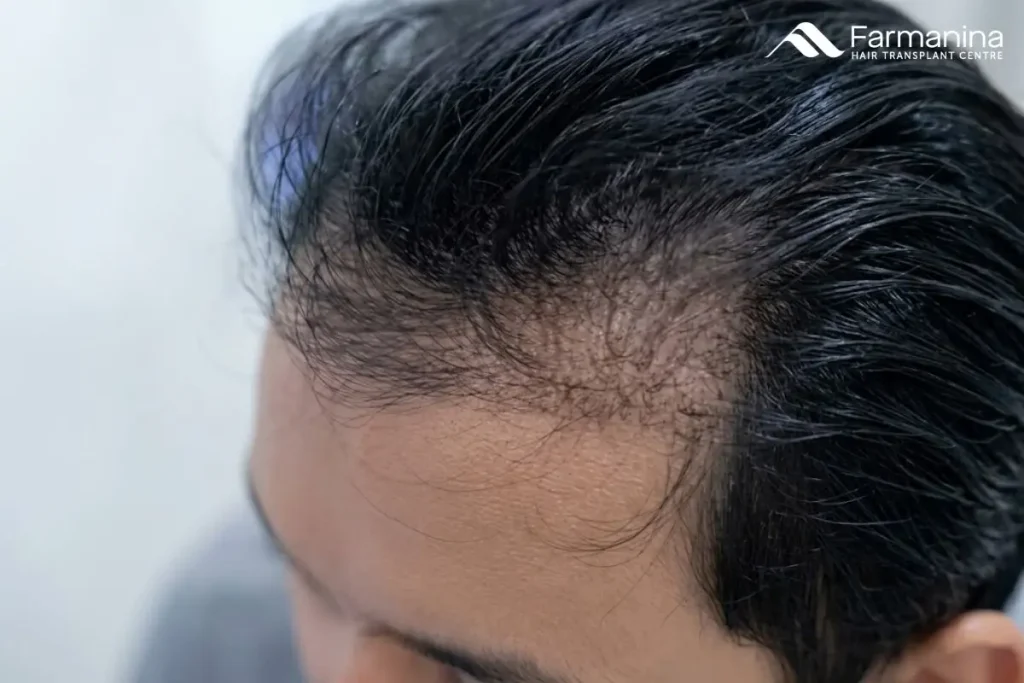 Rambut rontok dan botak