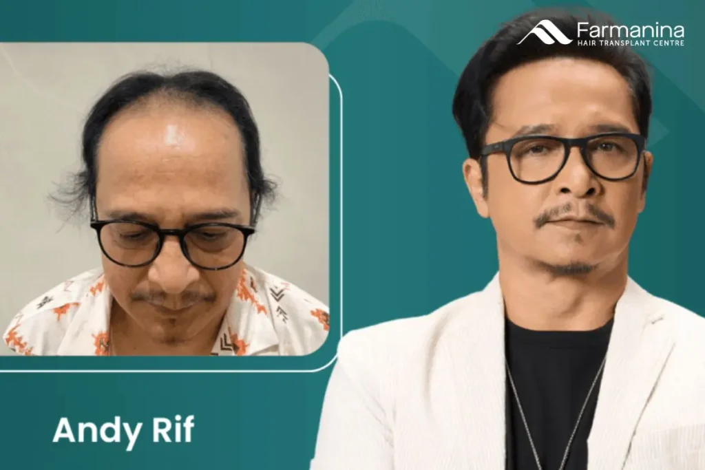 Before After hair transplant di Farmanina Clinic