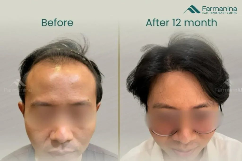 Before After tanam rambut di Farmanina Clinic.