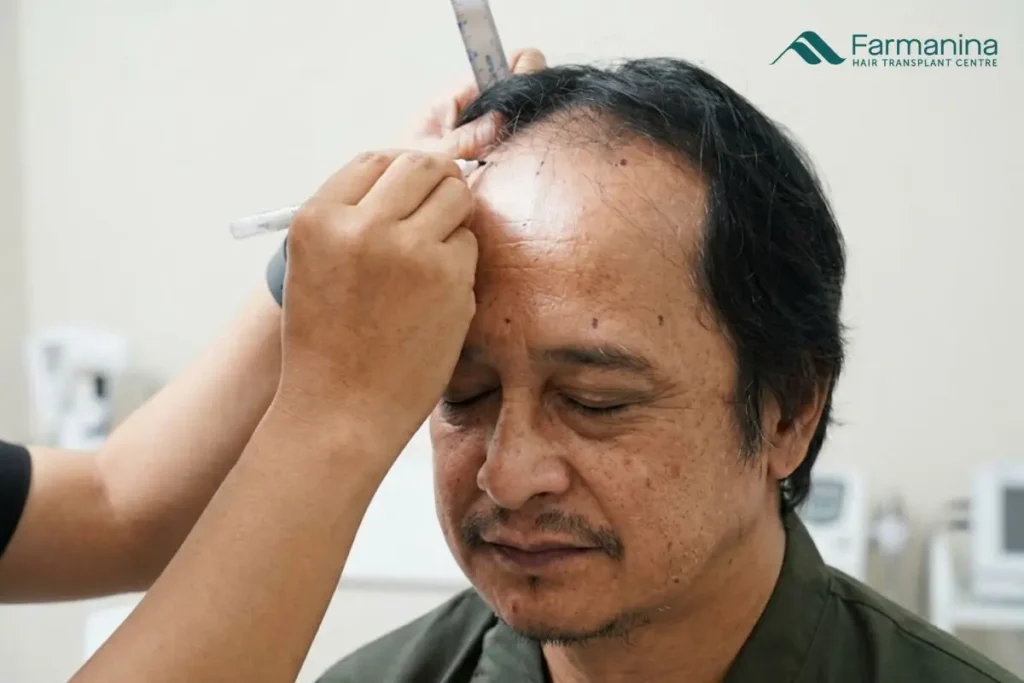 Kondisi kebotakan androgenic alopecia