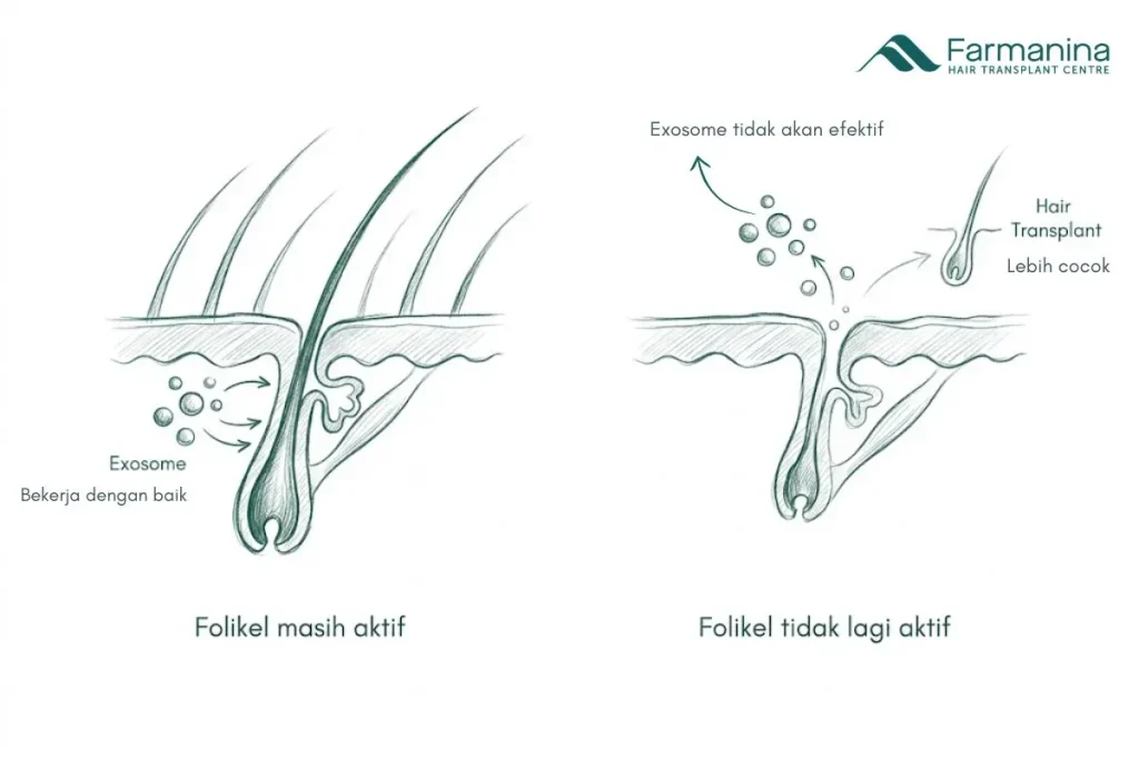 Kondisi rambut yang sesuai untuk hair exosome therapy.