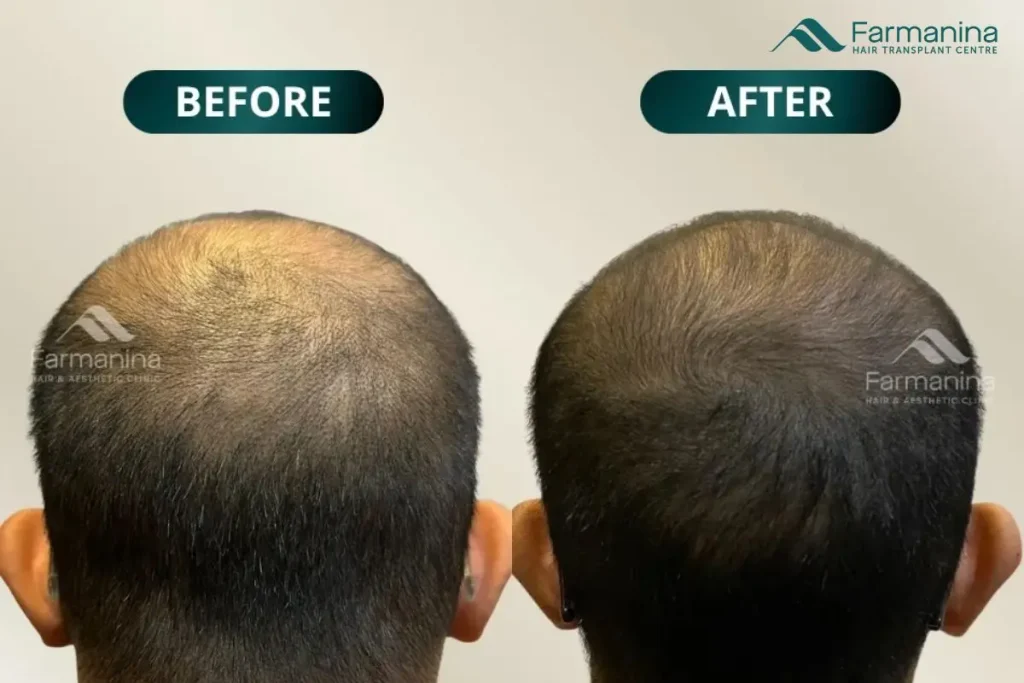 Before-after hair exosome therapy di Farmanina Clinic.
