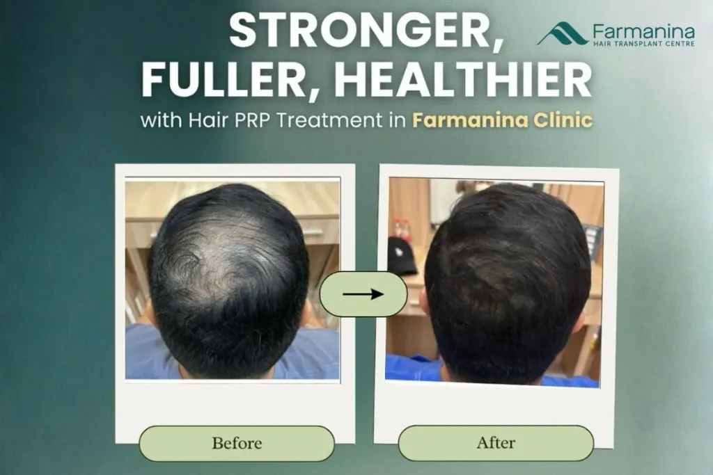 Hasil PRP rambut di Farmanina Clinic