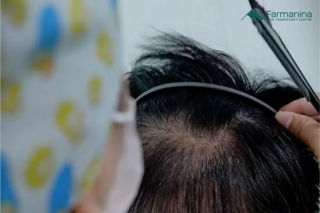 Penipisan rambut